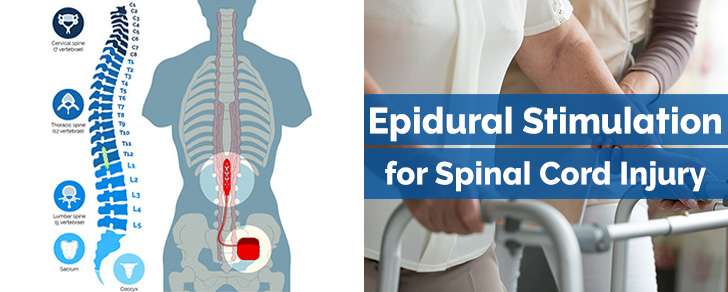 Epidural Stimulation for Spinal Cord Injury